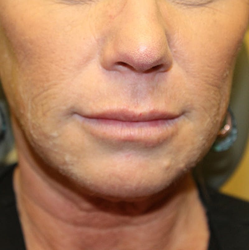 Dermal Fillers Before & After