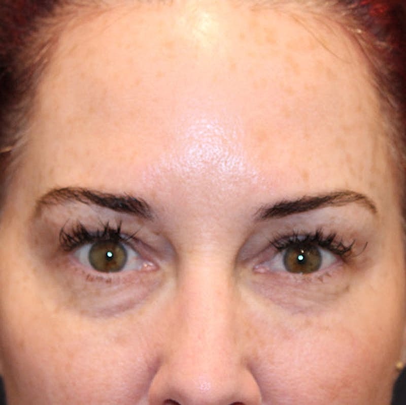 Dermal Fillers Before & After