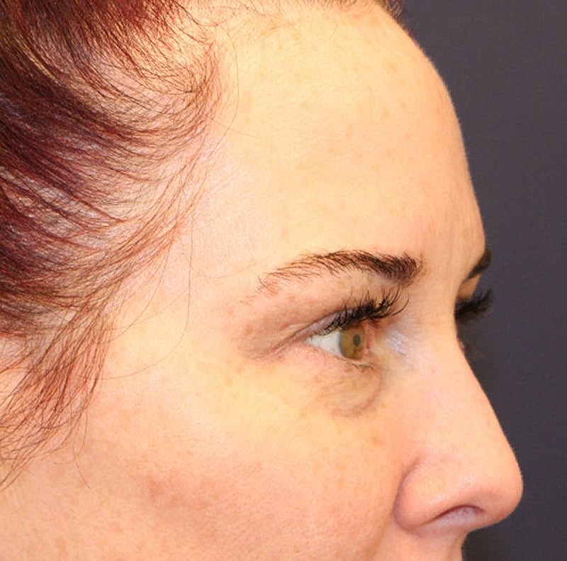 Dermal Fillers Before & After
