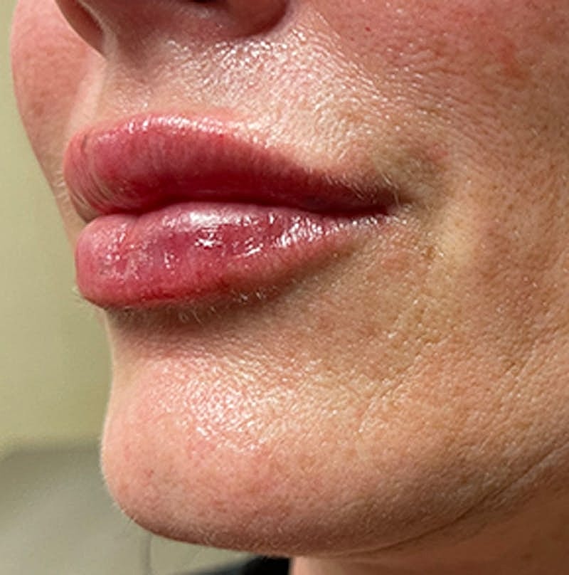 Dermal Fillers Before & After