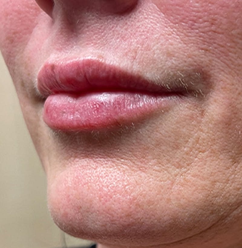 Dermal Fillers Before & After