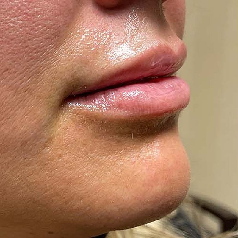 Dermal Fillers Before & After