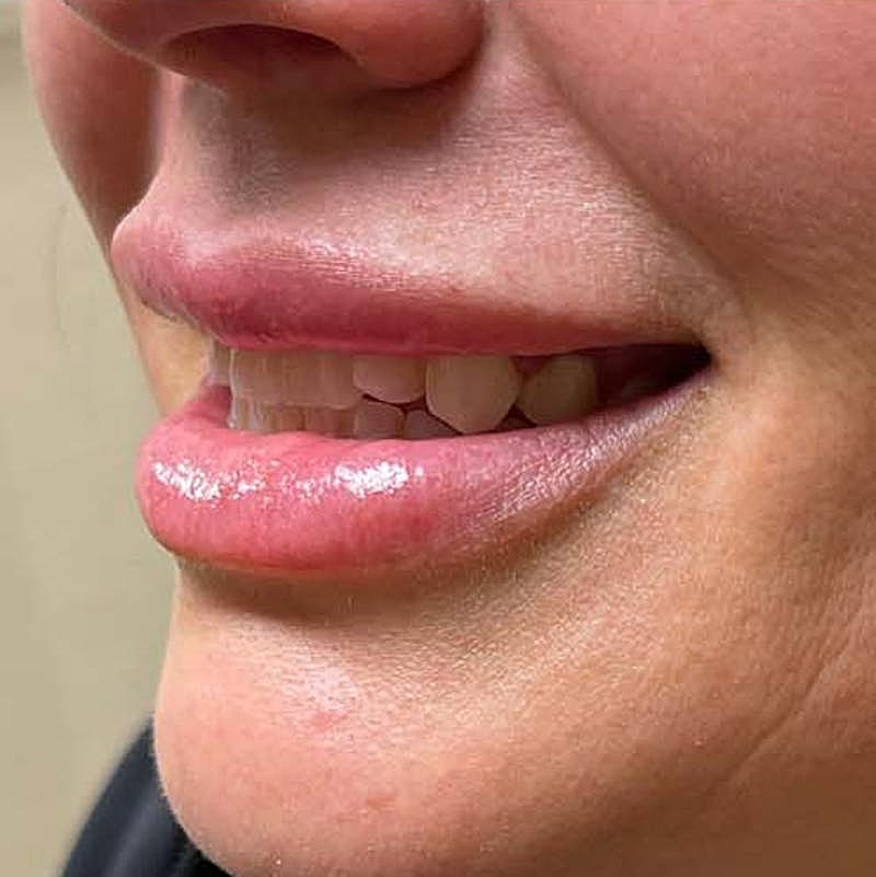 Dermal Fillers Before & After