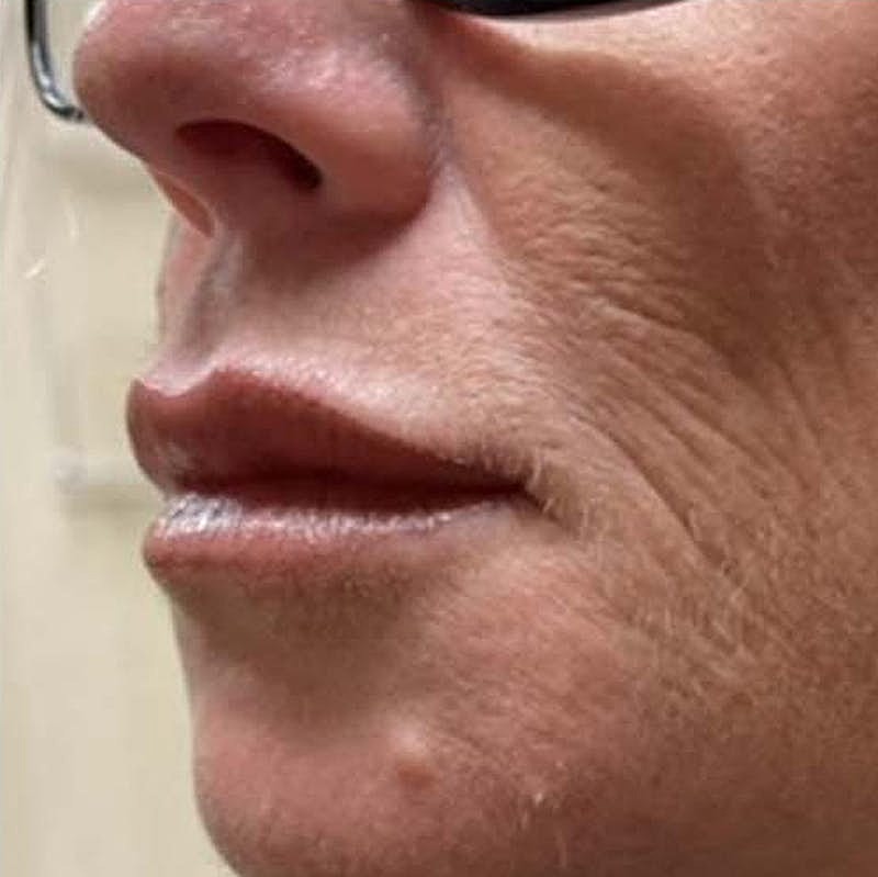 Dermal Fillers Before & After
