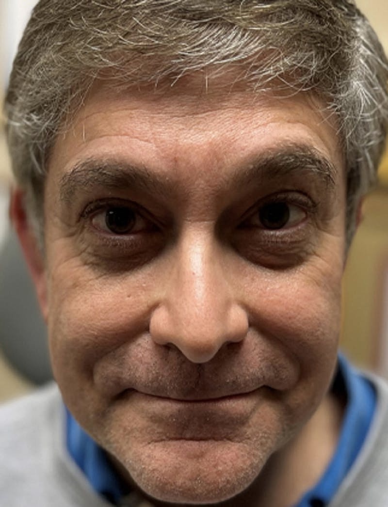 Dermal Fillers Before & After