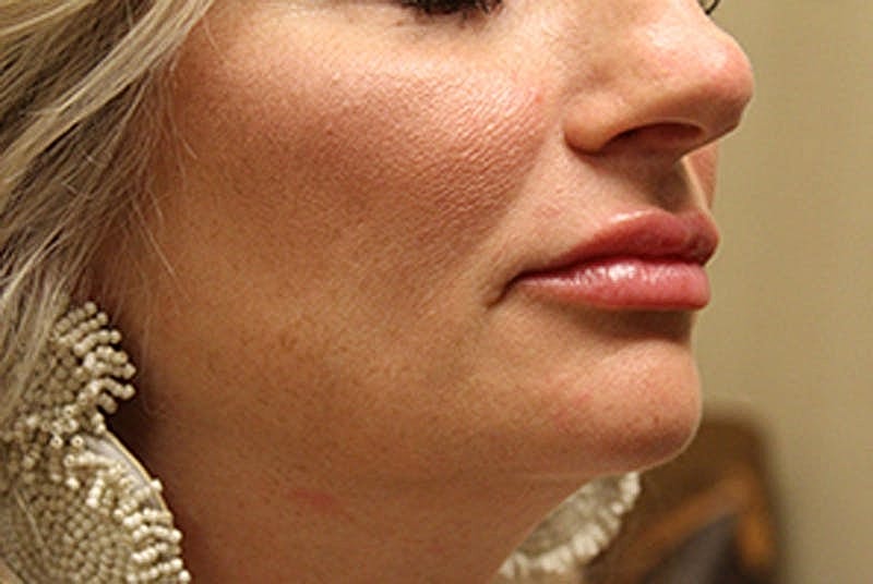 Dermal Fillers Before & After