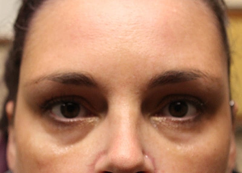 Dermal Fillers Before & After