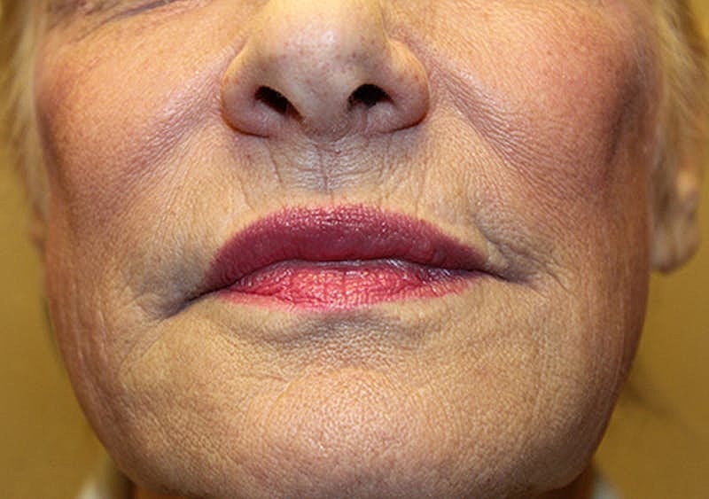 Dermal Fillers Before & After