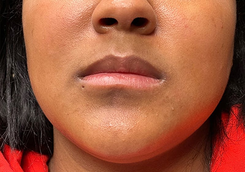 Dermal Fillers Before & After