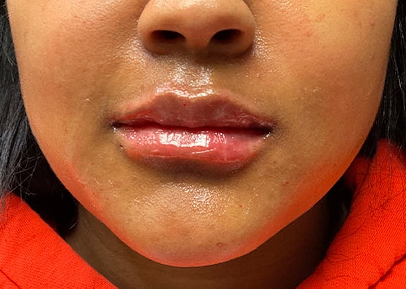 Dermal Fillers Before & After