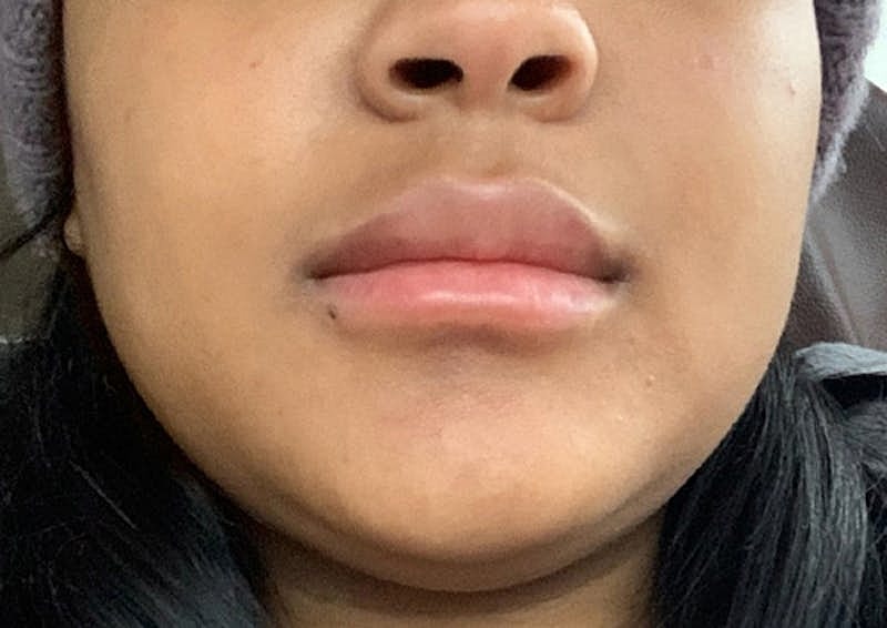 Dermal Fillers Before & After