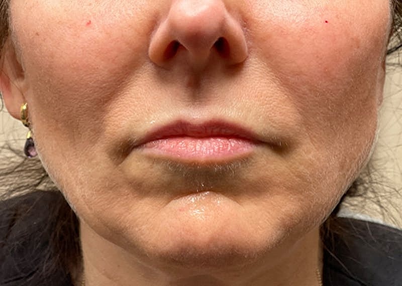 Dermal Fillers Before & After