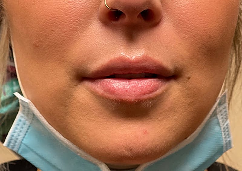 Dermal Fillers Before & After