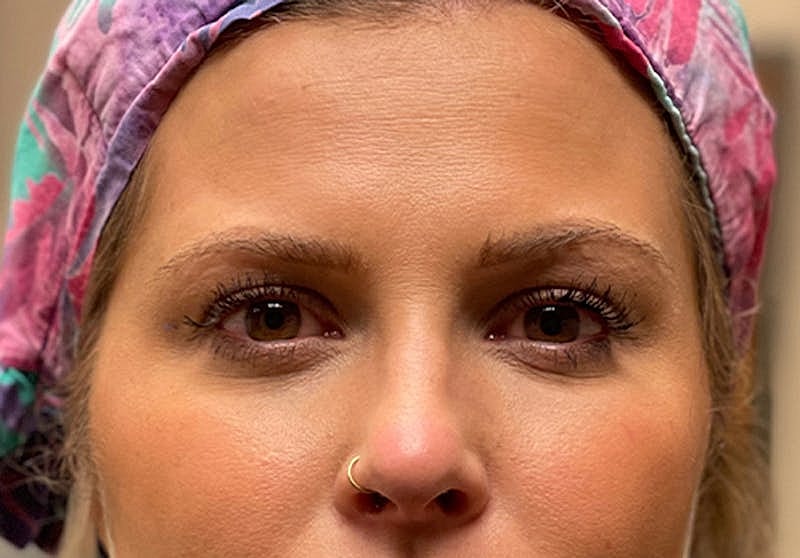 Dermal Fillers Before & After