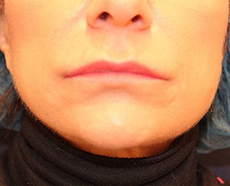 Dermal Fillers Before & After