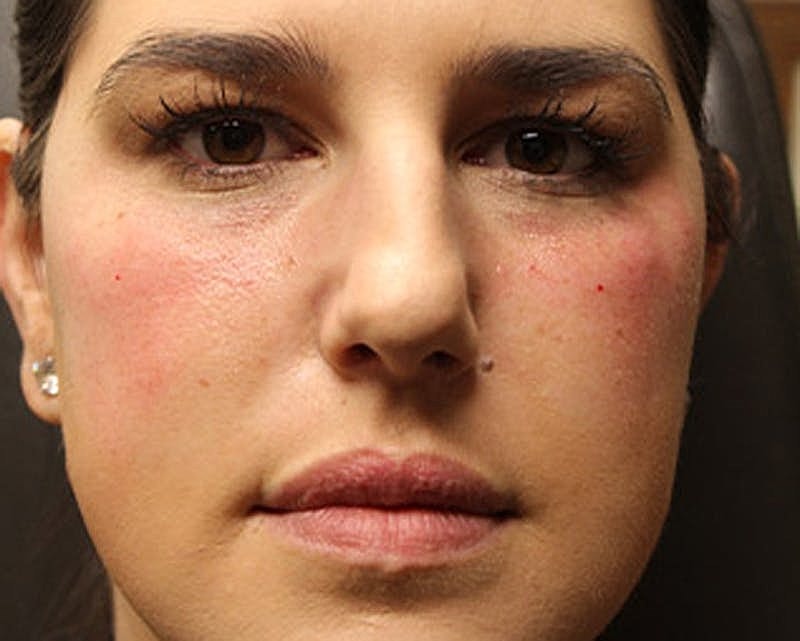 Dermal Fillers Before & After