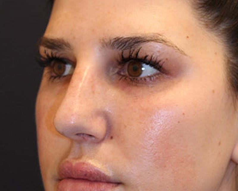 Dermal Fillers Before & After