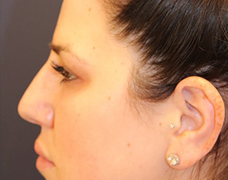 Dermal Fillers Before & After