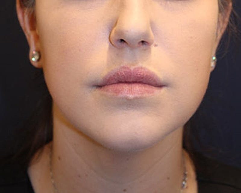 Dermal Fillers Before & After