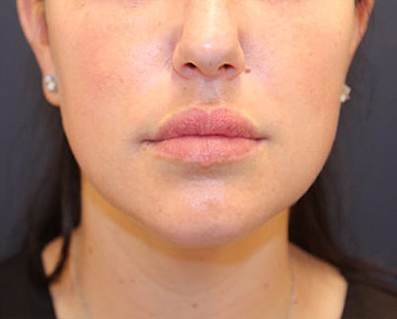 Dermal Fillers Before & After