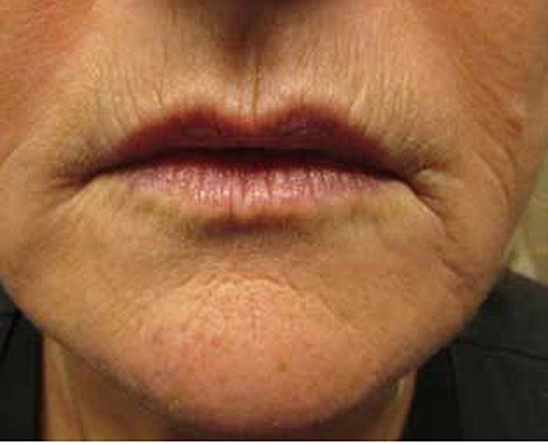 Dermal Fillers Before & After