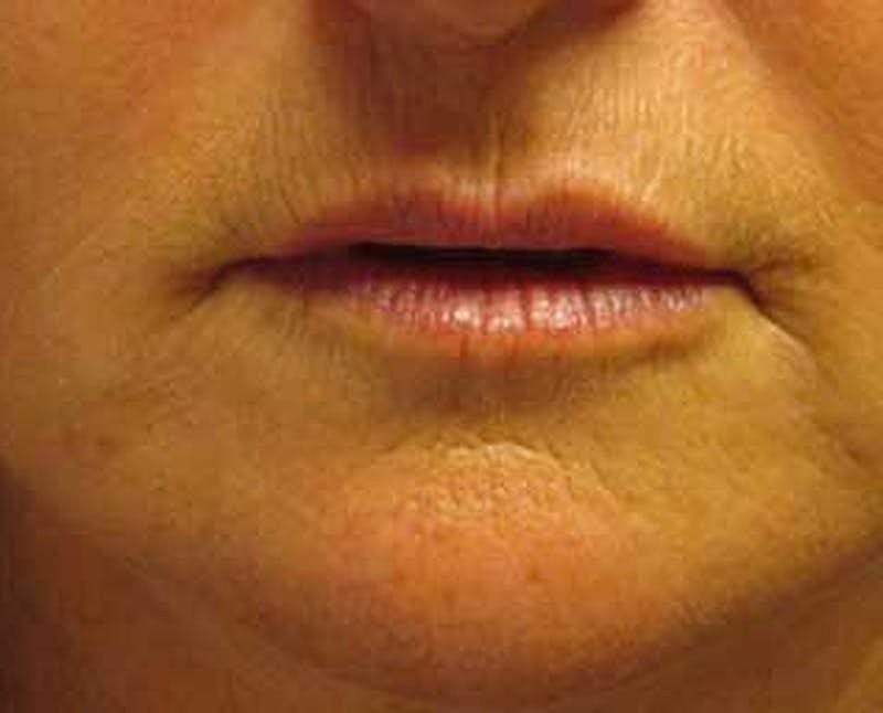 Dermal Fillers Before & After