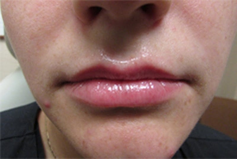 Dermal Fillers Before & After