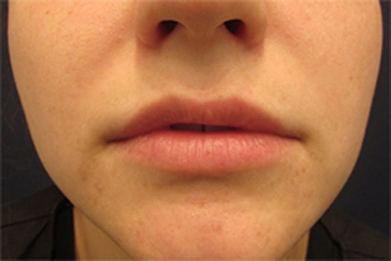 Dermal Fillers Before & After