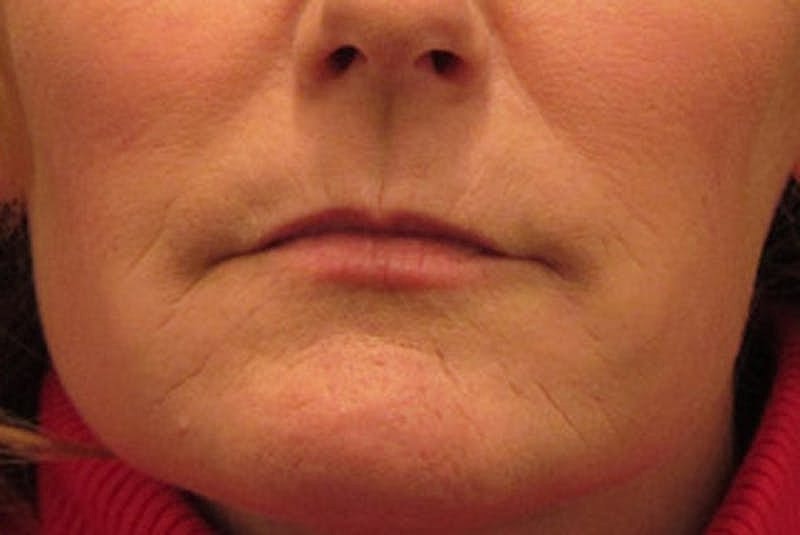 Dermal Fillers Before & After