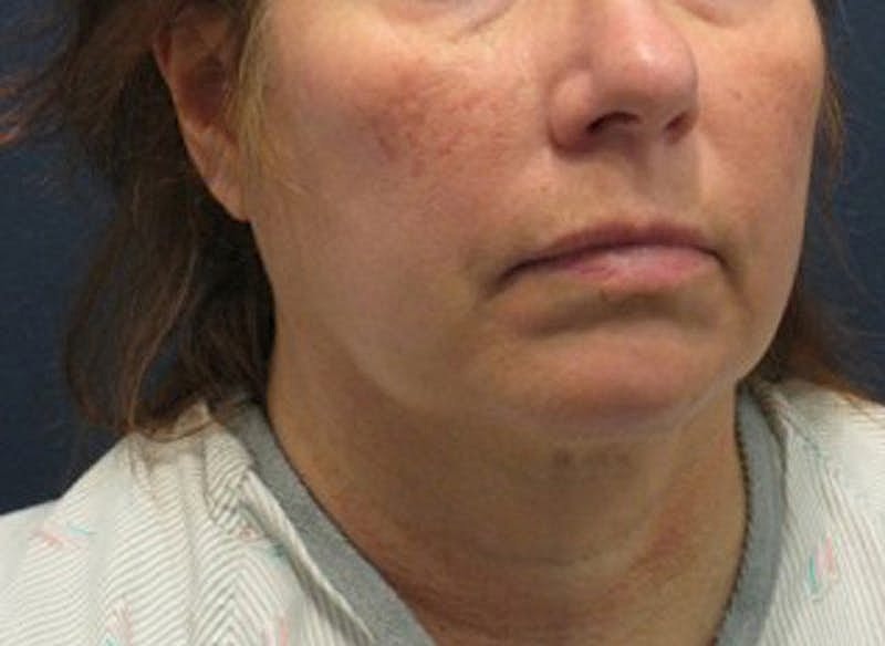 Dermal Fillers Before & After