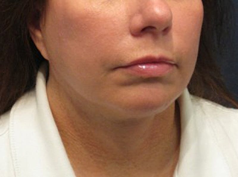 Dermal Fillers Before & After