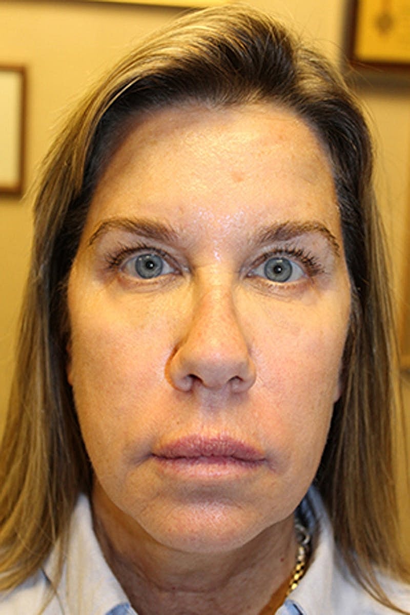 Dermal Fillers Before & After