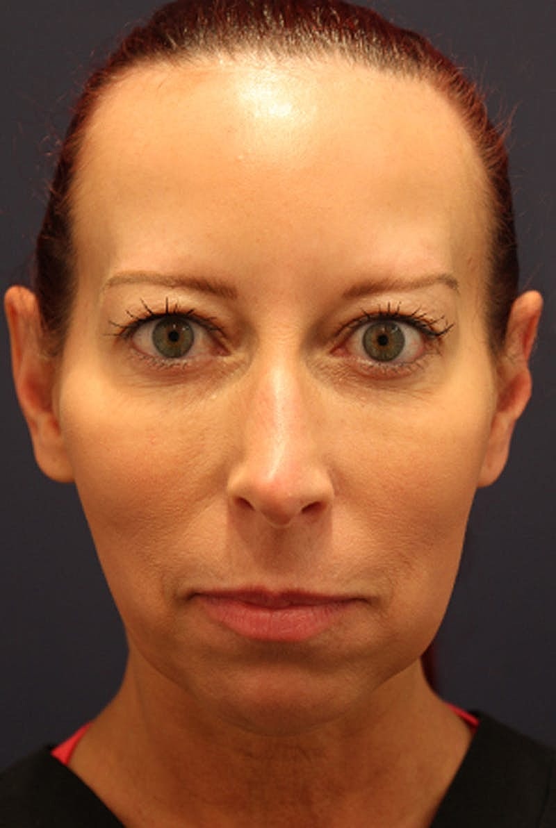 Dermal Fillers Before & After