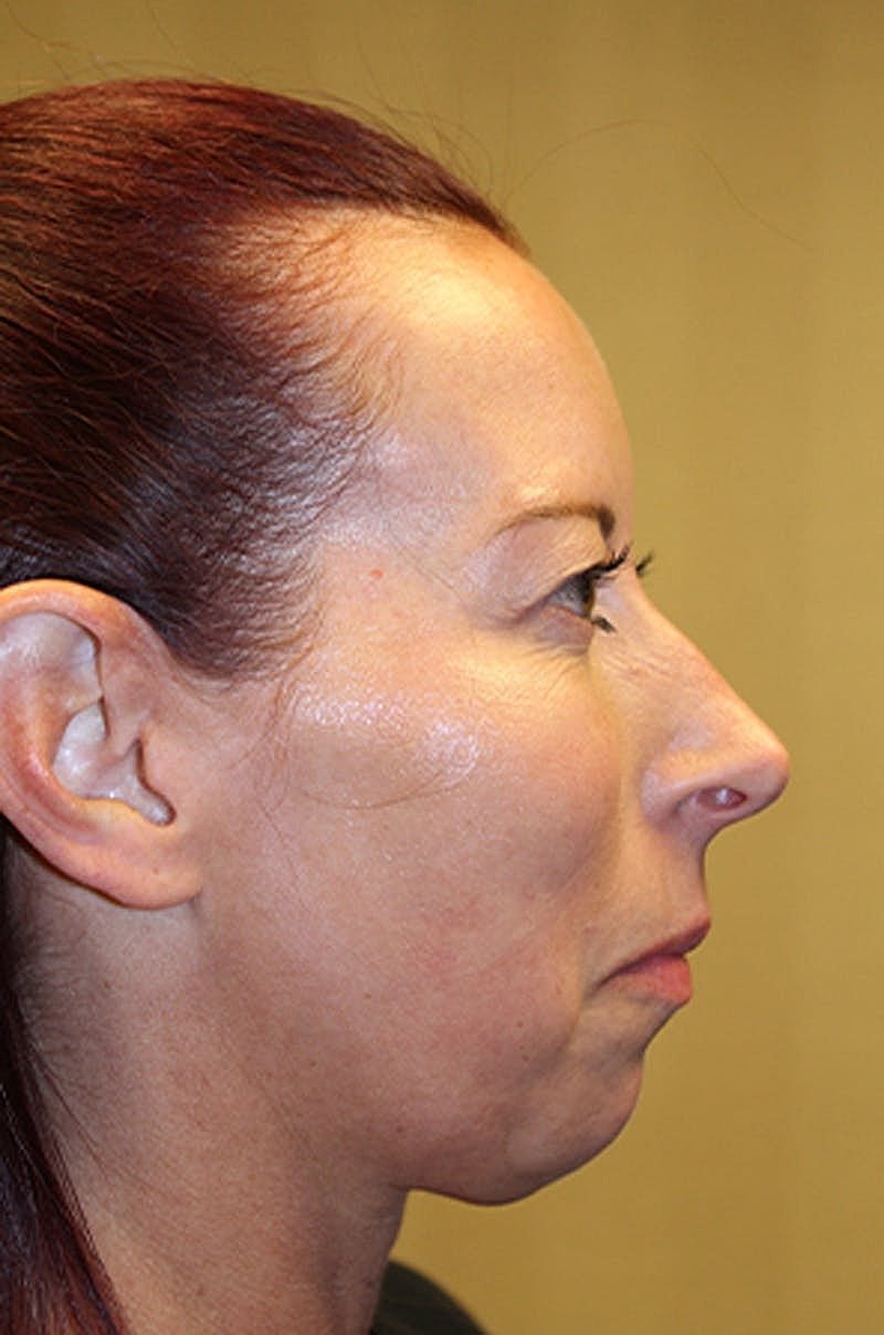 Dermal Fillers Before & After