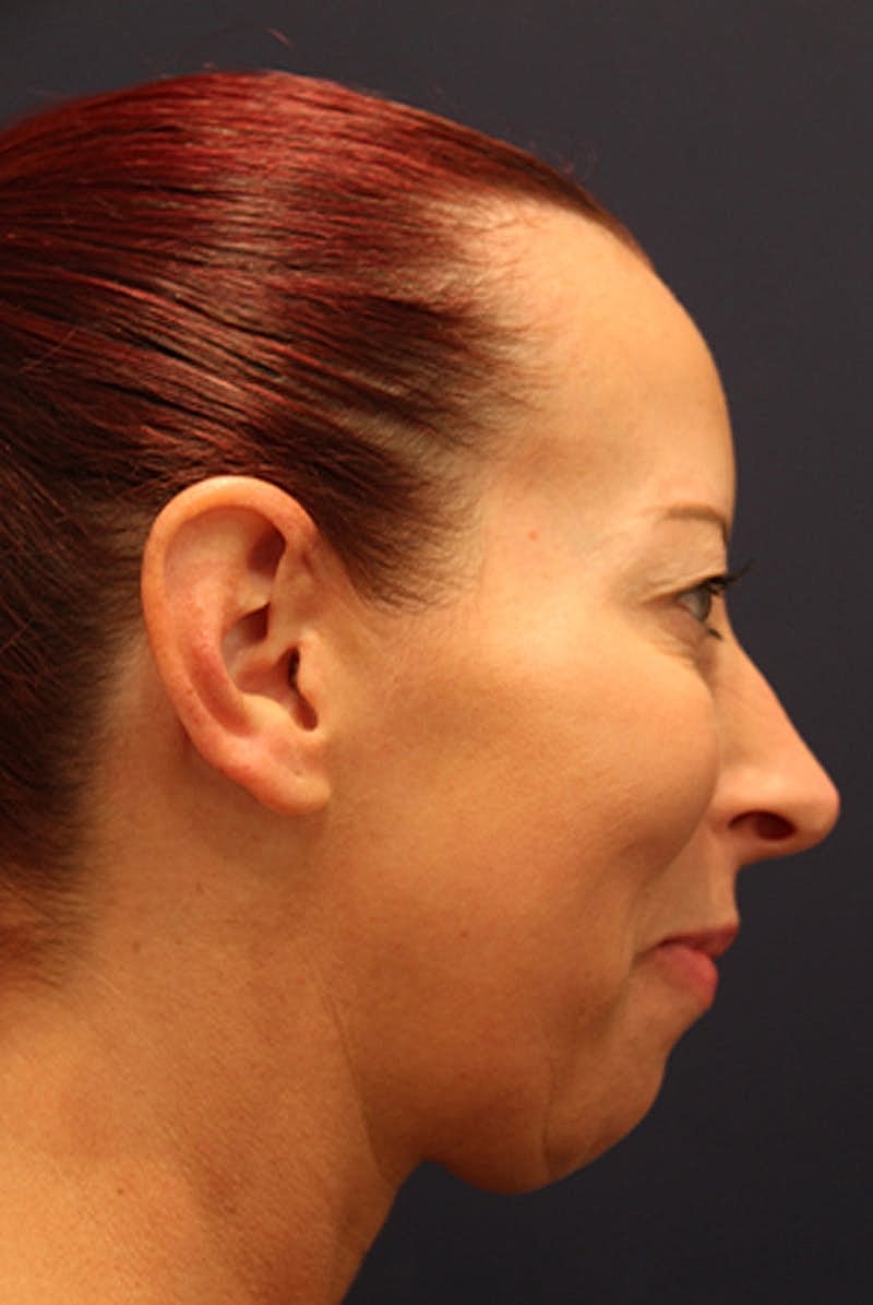 Dermal Fillers Before & After