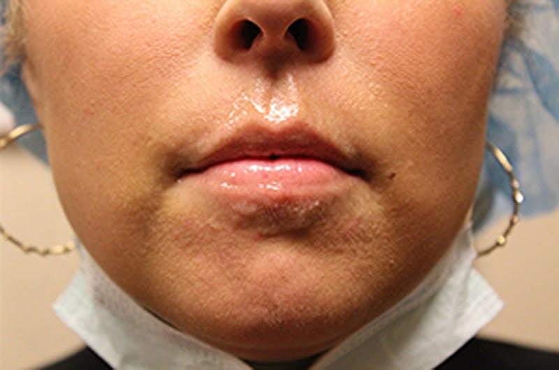 Dermal Fillers Before & After