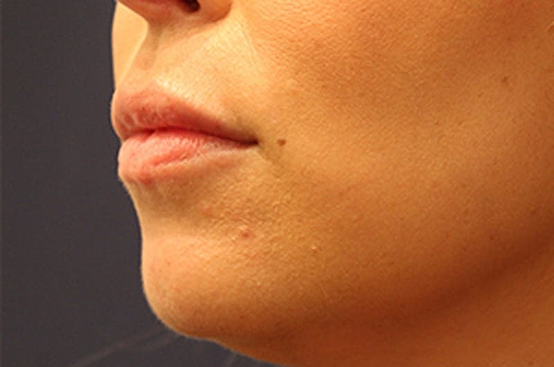 Dermal Fillers Before & After