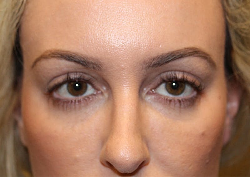 Dermal Fillers Before & After