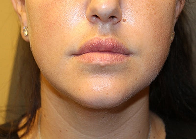 Dermal Fillers Before & After