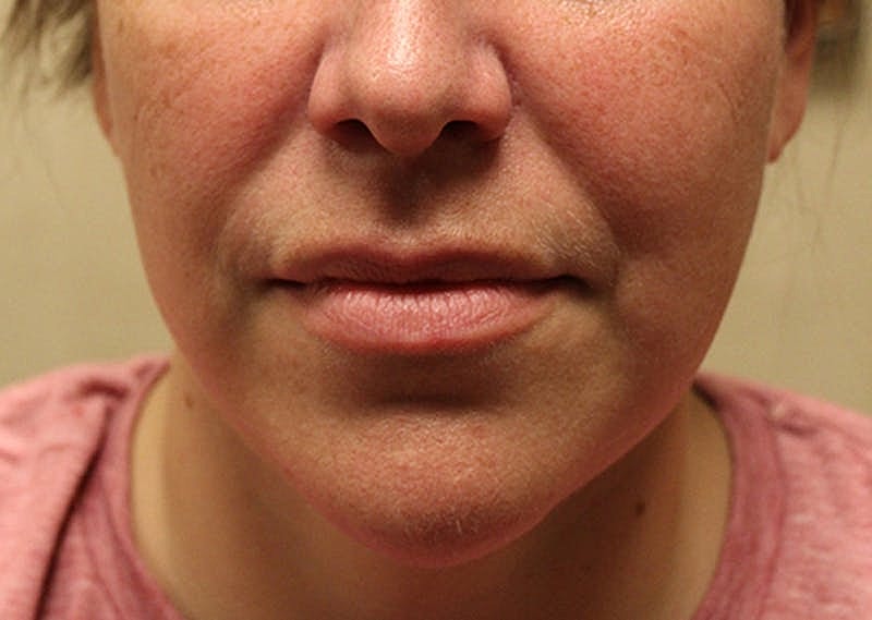 Dermal Fillers Before & After