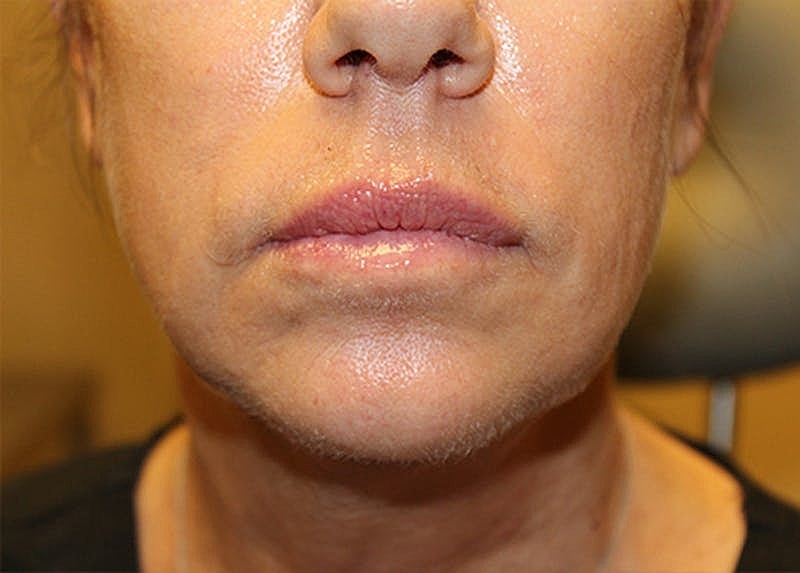 Dermal Fillers Before & After