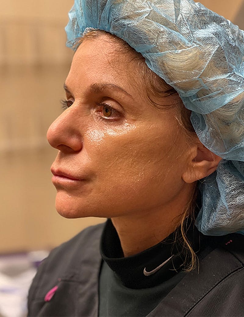 Dermal Fillers Before & After