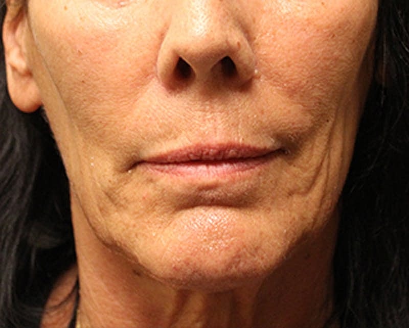 Dermal Fillers Before & After