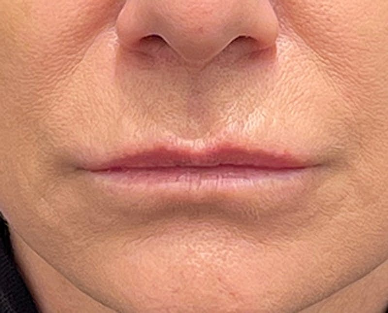 Dermal Fillers Before & After