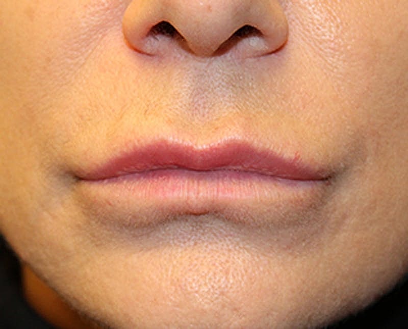 Dermal Fillers Before & After