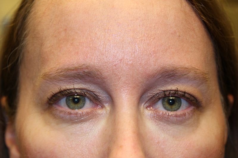 Dermal Fillers Before & After