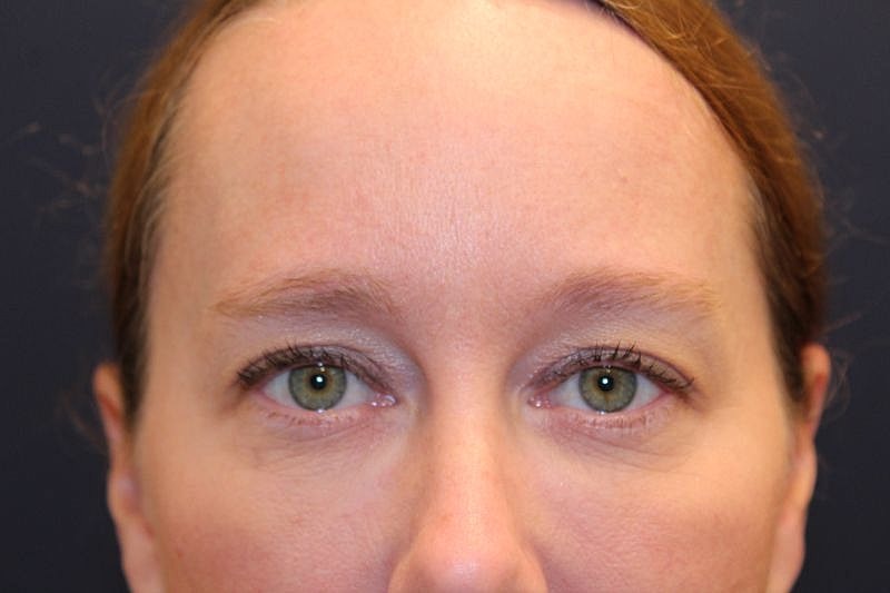 Dermal Fillers Before & After