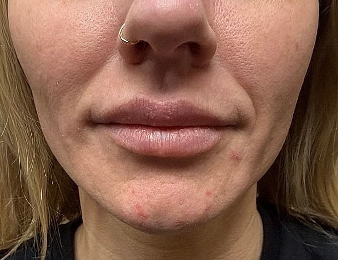 Dermal Fillers Before & After