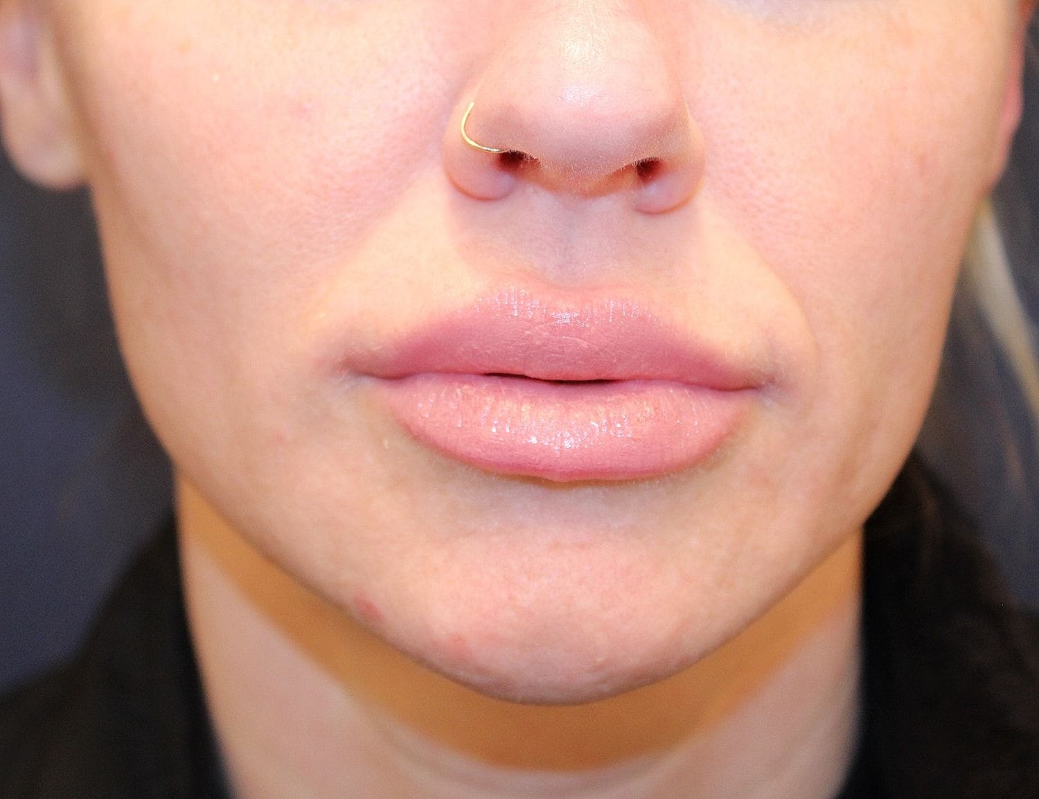 Dermal Fillers Before & After