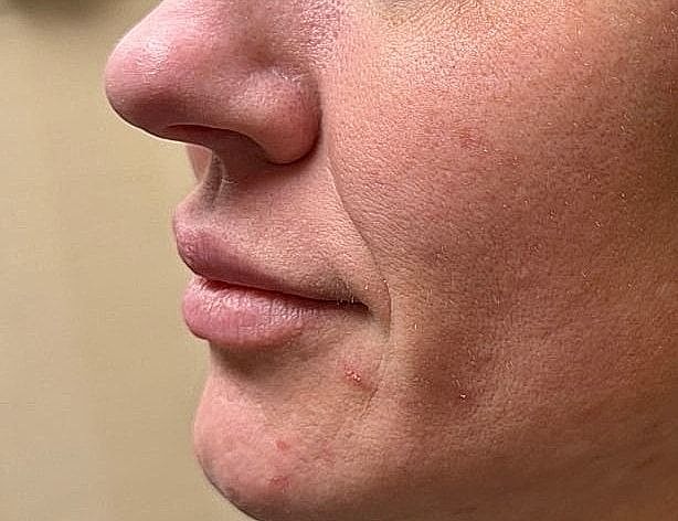 Dermal Fillers Before & After